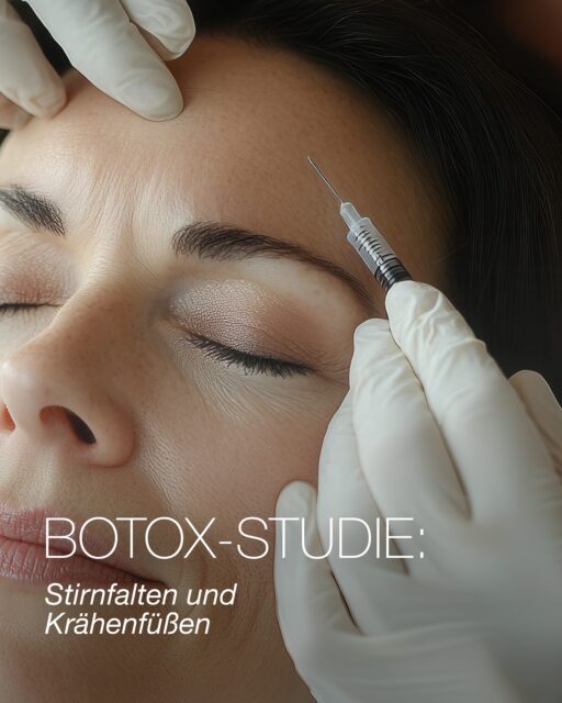 ✨Botox study✨Smoother skin, fewer expression lines - and scientifically monitored 💉We are looking for participants for our Botox study (forehead wrinkles & crow's feet).📩 Interested? Just send us an email - information will follow! #botox #study #noahklinik ##crowsfeet #beautyinnovation
