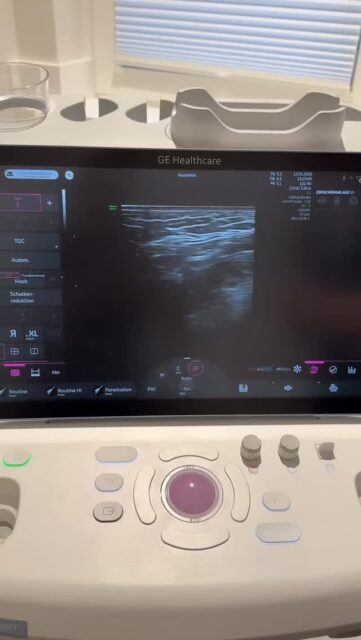 Was macht Professor Noah hier eigentlich? ✨ Ein Ultraschallgerät der Spitzenklasse, ein zentrales Tool in der modernen ästhetischen Medizin. Eingesetzt für präzise Injektionen, die sichere Auflösung von Hyaluronsäure, die Brustdiagnostik sowie zur Detektion von Seromen und Flüssigkeitsansammlungen. In Zukunft auch essenziell für unsere Arbeit mit der MIA-FemTech-Methode.✨ #profnoah #noahklinik #plastischechirurgie #miafemtech