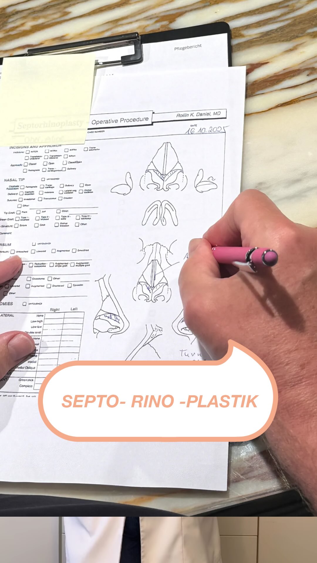 ✨Komplexe Nasenchirurgie – sichtbar gemacht✨ Gerade bei anspruchsvollen Eingriffen wie der Septorhinoplastik hilft eine schematische Zeichnung, operative Veränderungen klar festzuhalten. Sie ergänzt die Dokumentation, macht chirurgische Entscheidungen nachvollziehbar und unterstützt die präzise Nachbereitung des Eingriffs. Ein fester Bestandteil unserer chirurgischen Arbeitsweise. ✨ Habt ihr noch Fragen? Schreibt sie uns in die Kommentare. #septorhinoplasty #faceliftdoc #noahklinik #kassel #plasticsurgery