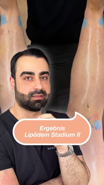 Before ➡️ After Lipoedema stage 2 - impressive results after the operation! 💉#ransformation 1TP5Lipoedema treatment #noahklinikkassel 1TP5Lipoedema 1TP5Plastic surgery