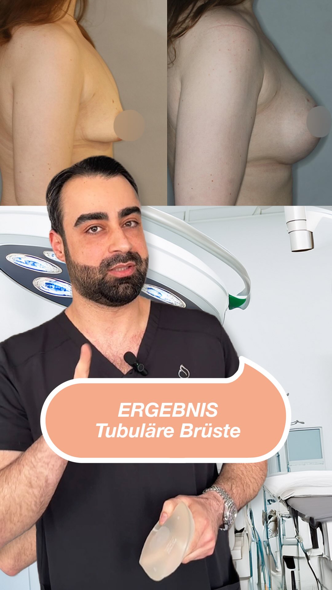 Die Korrektur tubulärer Brüste kann nicht nur die Form harmonisieren, sondern auch das persönliche Wohlbefinden stärken. Jeder Eingriff ist individuell- genau wie unsere Patientinnen. #brustkorrektur #tubulärebrust #noahklinikkassel #plastischechirurgie