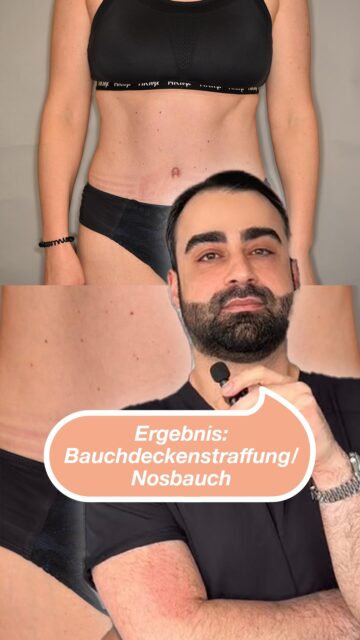 Nach der Bauchdeckenstraffung zeigt sich nicht nur ein flacherer Bauch sondern ein ganz neues Körpergefühl 💫 💬 Du denkst über eine Veränderung nach? Wir beraten dich ehrlich und persönlich.#noahklinik #plastischechirurgie #transformation #aesthetic #bauchdeckenstraffung
