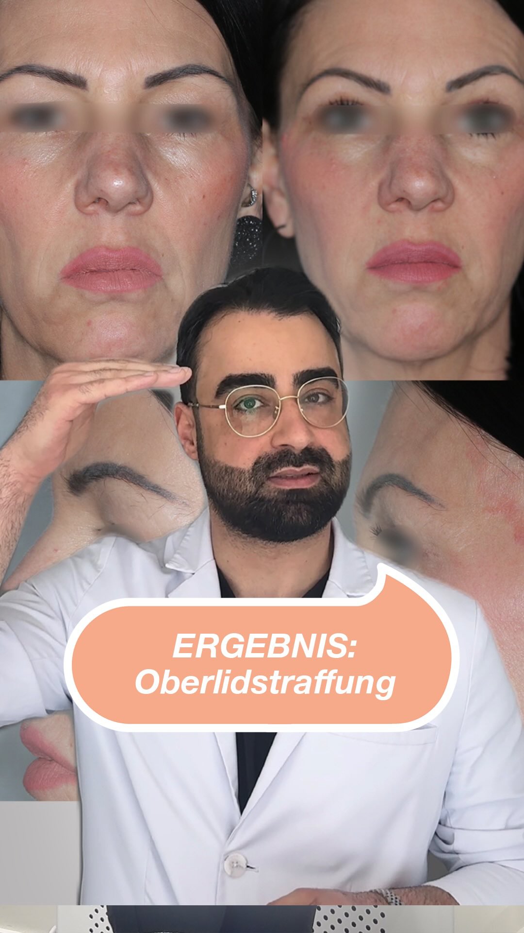 Oberlidstraffung nach Dr. Massry Technik ✨ (Medizinische Indikation) Für einen wachen, natürlichen Blick – ohne den Ausdruck zu verändern 👁️💙 #noahklinik #plastischechirurgie #oberlidstraffung #noahklinikkassel #massryeyes