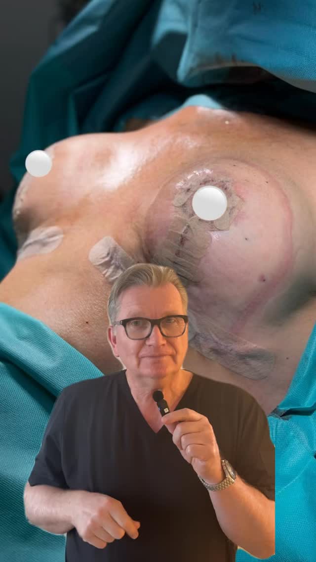 Von D auf C - natürliche Form, weniger Gewicht, mehr Wohlgefühl. Natürlich. Harmonisch. Genau richtig ✨ #noahklinik #kassel #plastischechirurgie #brustreduktion #ästhetischechirurgie