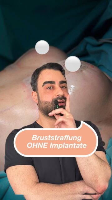 Bruststraffung OHNE Implantate Mastopexie mit Autoprothese für eine natürliche Form und ein harmonisches, körpergerechtes Ergebnis. Dabei wird körpereigenes Gewebe genutzt, um Volumen und Kontur sanft zu formen - ganz ohne Fremdmaterial. #Bruststraffung #Mastopexie #Autoprothese #ÄsthetischeChirurgie #NoahKlinik