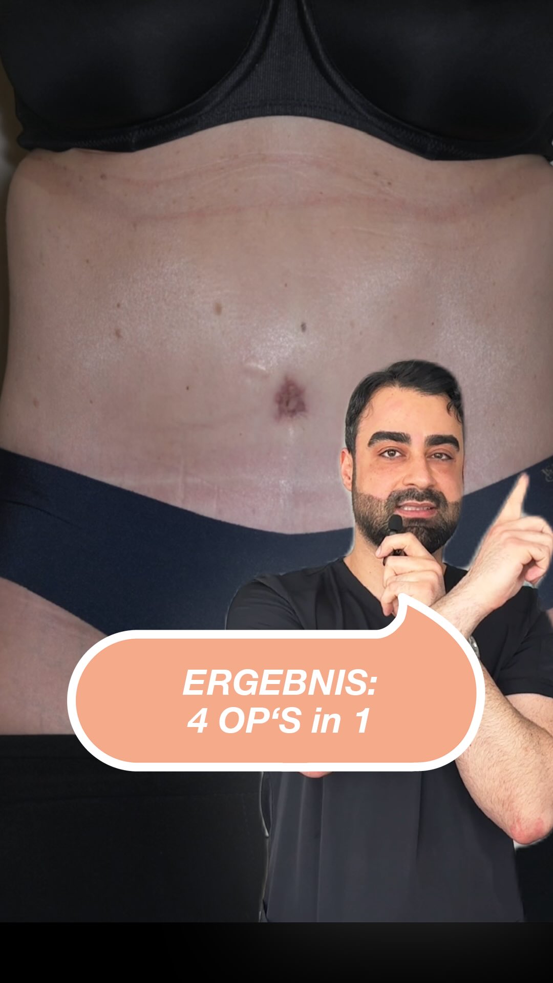 Bauchstraffung mit medizinischer Indikation. Ein klarer Einblick in den Heilungsverlauf und das frühe Ergebnis nach der Operation. Jede Behandlung ist individuell und erfolgt nach sorgfältiger medizinischer Abklärung. #Bauchstraffung #Abdominoplastik #ÄsthetischeChirurgie #MedizinischeIndikation #NoahKlinik