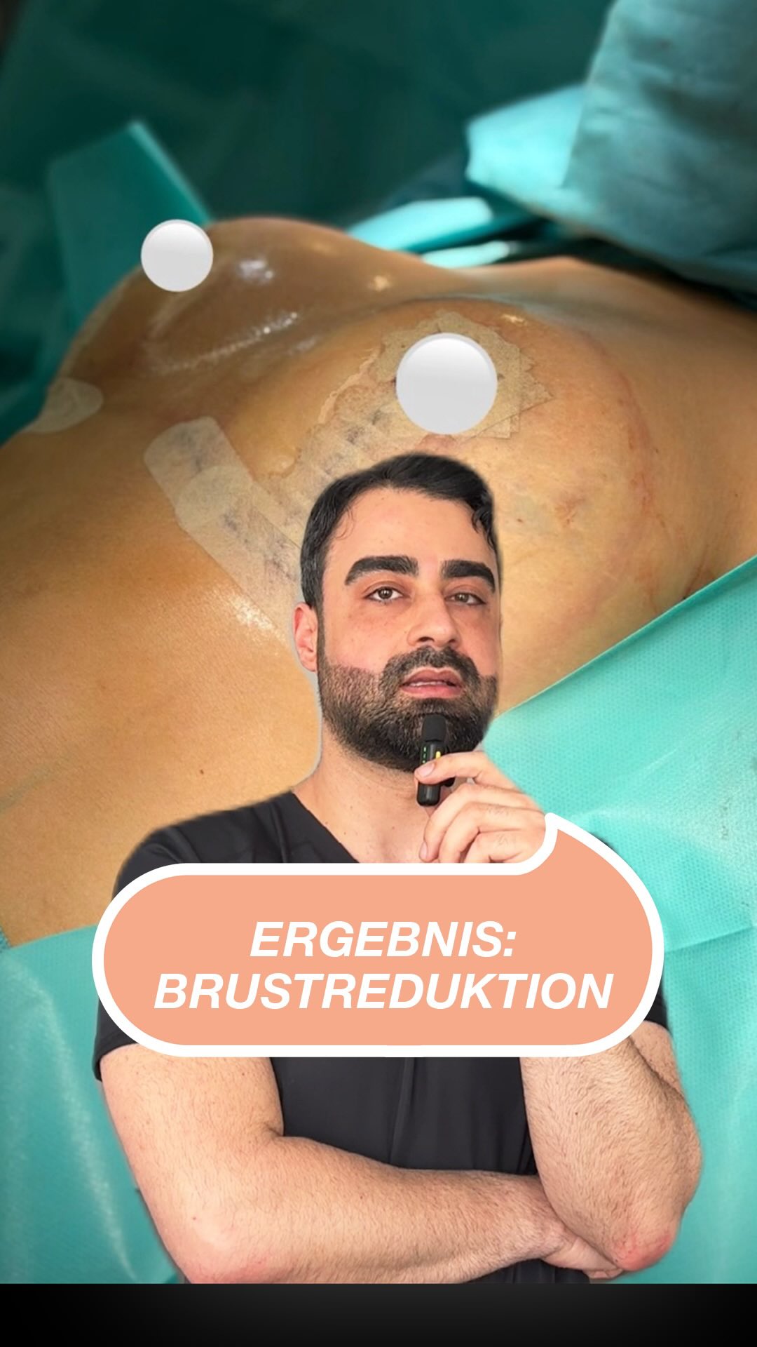 Brustverkleinerung von D auf ein volles B! Abgestimmt auf die Proportionen der Patientin für ein natürliches, ästhetisches Ergebnis. #noahklinik #plastischechirurgie #ästhetischechirurgie #brustreduktion #noahklinikkassel