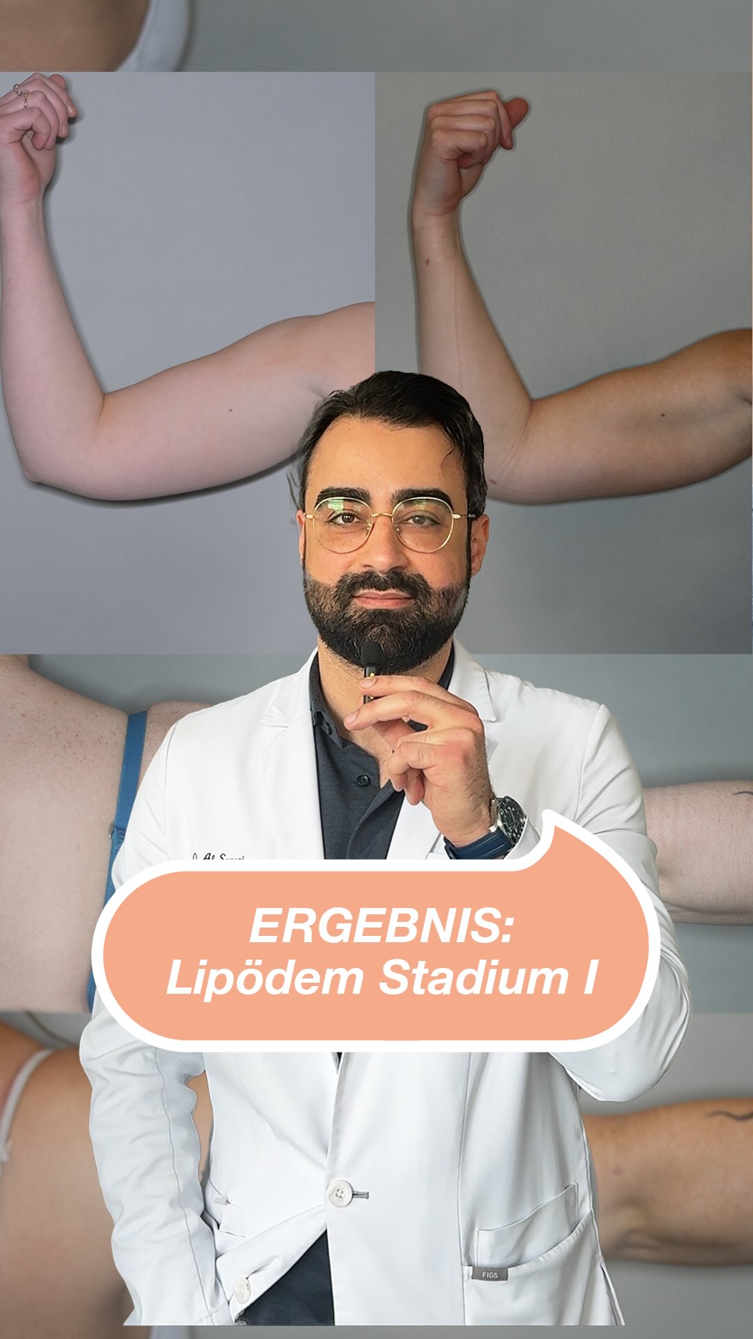 Ergebnis nach Lipödem Stadium 1 / medizinische Indikation Zu sehen: Oberarme nach Fettabsaugung mit moderner Quantum-Technologie. Ziel der Behandlung ist es, die Proportionen zu harmonisieren und Beschwerden nachhaltig zu lindern – individuell abgestimmt auf jede Patientin. 👉 Du hast Fragen zum Lipödem oder zur Behandlung? Wir beraten dich gerne. #fettabsaugung #quantumtechnologie #lipomar #lipödem #noahklinikkassel