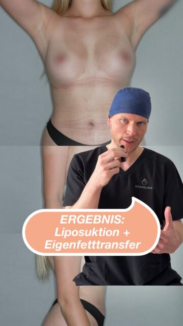 For more information 👇This result shows that breast augmentation is often about much more than just „size“.For our patient (55 kg, 1.65 m), the focus was on natural shaping and the equalisation of anatomical features.The initial situation/findings of the breasts:The anatomical conditions were:- An existing keel chest in the upper third of the thorax.- A clear volume asymmetry of approx. 80 ml between the right and left side.- Different heights of the underbust folds (IMF) and nipples. Different heights of the underbust folds (IMF) and nipplesOur solution: a balancing lipofilling (autologous fat transfer)In order to achieve a harmonious C-cup without implants, we opted for the body's own method.Body contouring: The high-quality donor fat was obtained by means of liposuction (suction) on the inner thighs and abdomen.Transfer to the breasts: In order to balance out the asymmetry as precisely and symmetrically as possible, the right breast was relined with 236 ml and the left breast with 150 ml of pure fat aspirate.The resultThe after picture shows a symmetrical, harmonious breast shape that fits the patient's petite proportions very well. The keel breast and the difference in volume between the breasts were harmoniously balanced.Advantages in this case:✅ No foreign bodies (implant-free)✅ Simultaneous contouring of the donor areas (abdomen & legs)✅ A result that feels absolutely natural and ages with the patient.📍 Advice & expertise:Every breast is individual. Particularly in the case of thoracic deformities or asymmetries of the breasts, detailed planning (as here by Dr Eric Klingelhöfer) is crucial for an aesthetic end result.#drericklingelhöfer #lipofilling 1TP5Breast augmentation 1TP5Plastic surgery #noahklinik