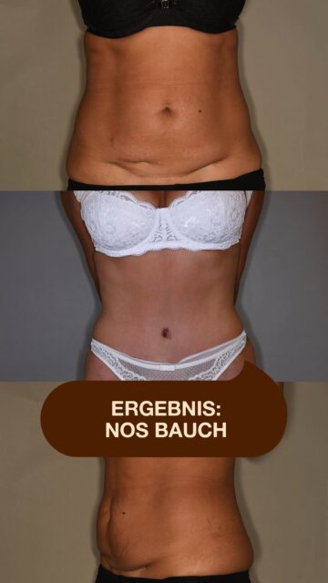 Rektusdiastase & Kaiserschnittnarbe – mehr als nur Ästhetik. Eine geschwächte Bauchwand, Rückenschmerzen oder schmerzhafte Narbeneinziehungen können die Folge sein. Mit unserer NOS-Bauch-Technik behandeln wir ganzheitlich: ✔️ Rekonstruktion der Bauchwand ✔️ Korrektur eingezogener Kaiserschnittnarben ✔️ Entfernung überschüssiger Haut ✔️ Natürliche Bauchkontur Unser Ziel: Funktion und Ästhetik wiederherstellen – für ein stabiles, natürliches Körpergefühl. #noahklinik #plastischechirurgie #ästhetischechirurgie #bauchdeckenstraffung #lipomar