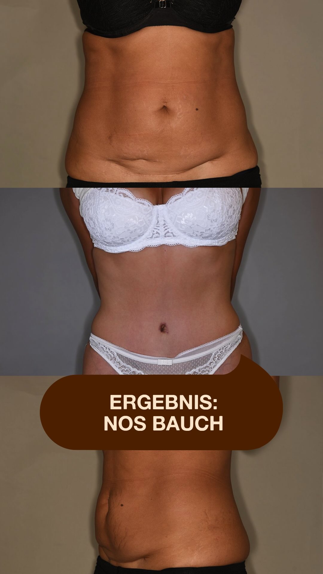 Rektusdiastase & Kaiserschnittnarbe – mehr als nur Ästhetik. Eine geschwächte Bauchwand, Rückenschmerzen oder schmerzhafte Narbeneinziehungen können die Folge sein. Mit unserer NOS-Bauch-Technik behandeln wir ganzheitlich: ✔️ Rekonstruktion der Bauchwand ✔️ Korrektur eingezogener Kaiserschnittnarben ✔️ Entfernung überschüssiger Haut ✔️ Natürliche Bauchkontur Unser Ziel: Funktion und Ästhetik wiederherstellen – für ein stabiles, natürliches Körpergefühl. #noahklinik #plastischechirurgie #ästhetischechirurgie #bauchdeckenstraffung #lipomar