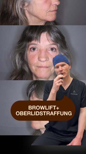 Beates Weg aus der Gesichtsfeldeinschränkung Die 64-jährige Beate stellte sich bei uns vor, weil ihre Augenlider über die Jahre immer schwerer wurden. Die medizinische Indikation: • Schwere Blepharochalasis: Der Hautüberschuss an den Oberlidern war so ausgeprägt, dass er bereits die Wimpernhärchen überlagerte. • Extrem starke Augenbrauenptosis: Die Augenbrauen hatten eine extrem niedrige Position, was den Druck auf die Augen zusätzlich verstärkte. Die Folge: Eine dauerhafte Einschränkung des Gesichtsfeldes und ein ständiges Schweregefühl. Operative Versorgung in Lokalanästhesie: • Direkte Augenbrauenanhebung zur Entlastung der Augenpartie. • Oberlidstraffung mit Entfernung der überschüssigen Haut sowie Reduktion eines hervorgetretenen nasalen Fettkompartiments. 3 Monate postoperativ: Die Narben verblassen bereits sehr schön. Vor allem aber kann Beate wieder uneingeschränkt und unbeschwert in die Welt blicken. Habt ihr Fragen zur Kombination aus Brauenlift und Oberlidstraffung? Schreibt sie gerne in die Kommentare. ⚠️ Rechtlicher Hinweis: Die postoperative Ergebnisdarstellung (3 Monate nach dem Eingriff) dient ausschließlich der medizinischen Aufklärung über die chirurgische Korrektur funktioneller Gewebeveränderungen und angeborener bzw. altersbedingter Formveränderungen (§ 11 HWG). Kein Heilversprechen. Die Patientin hat ihre ausdrückliche, schriftliche Einwilligung zur Veröffentlichung erteilt. #noahklinik #plastischechirurgie #oberlidstraffung #ästhetischechirurgie #browlift