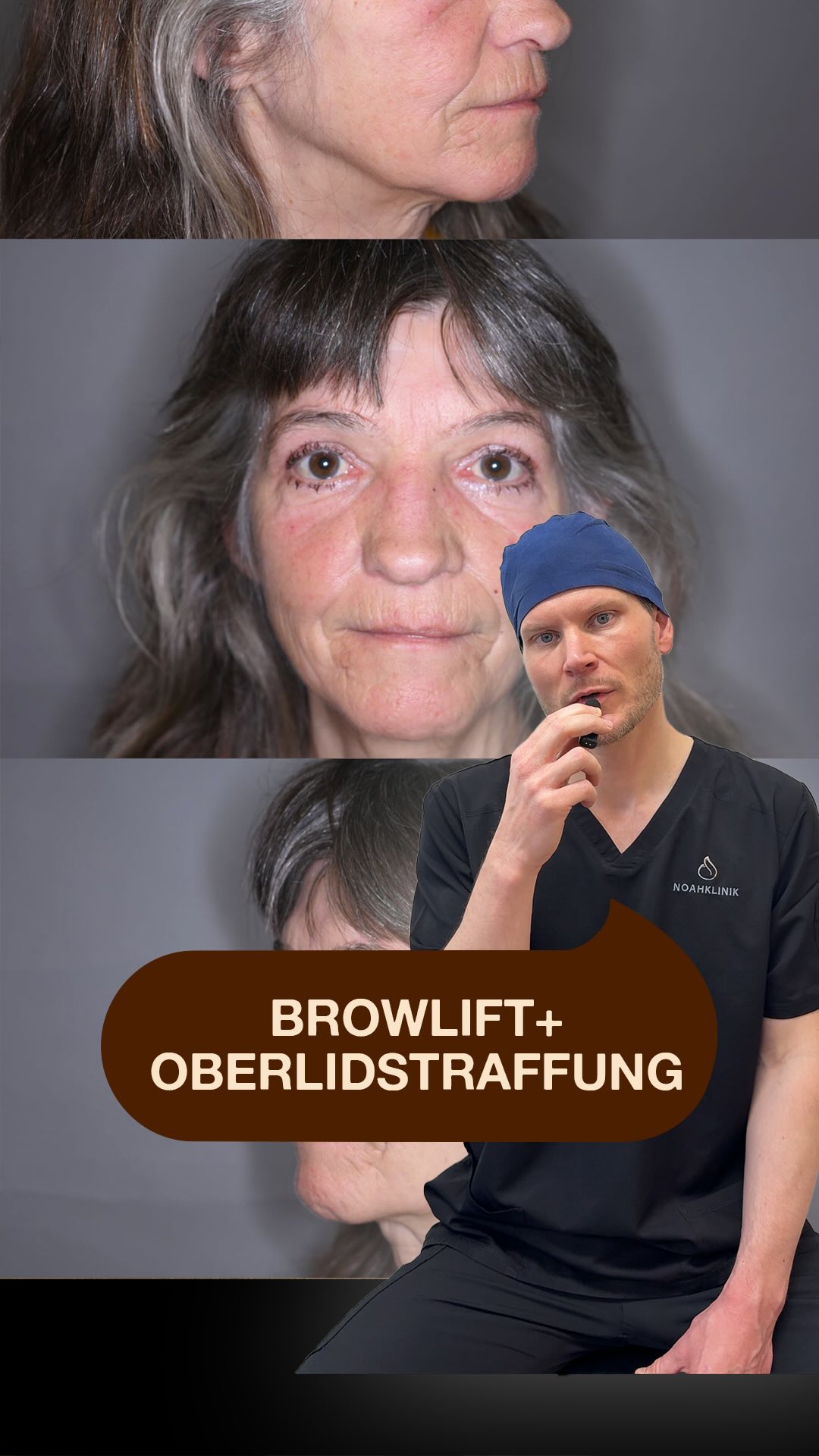 Beates Weg aus der Gesichtsfeldeinschränkung Die 64-jährige Beate stellte sich bei uns vor, weil ihre Augenlider über die Jahre immer schwerer wurden. Die medizinische Indikation: • Schwere Blepharochalasis: Der Hautüberschuss an den Oberlidern war so ausgeprägt, dass er bereits die Wimpernhärchen überlagerte. • Extrem starke Augenbrauenptosis: Die Augenbrauen hatten eine extrem niedrige Position, was den Druck auf die Augen zusätzlich verstärkte. Die Folge: Eine dauerhafte Einschränkung des Gesichtsfeldes und ein ständiges Schweregefühl. Operative Versorgung in Lokalanästhesie: • Direkte Augenbrauenanhebung zur Entlastung der Augenpartie. • Oberlidstraffung mit Entfernung der überschüssigen Haut sowie Reduktion eines hervorgetretenen nasalen Fettkompartiments. 3 Monate postoperativ: Die Narben verblassen bereits sehr schön. Vor allem aber kann Beate wieder uneingeschränkt und unbeschwert in die Welt blicken. Habt ihr Fragen zur Kombination aus Brauenlift und Oberlidstraffung? Schreibt sie gerne in die Kommentare. ⚠️ Rechtlicher Hinweis: Die postoperative Ergebnisdarstellung (3 Monate nach dem Eingriff) dient ausschließlich der medizinischen Aufklärung über die chirurgische Korrektur funktioneller Gewebeveränderungen und angeborener bzw. altersbedingter Formveränderungen (§ 11 HWG). Kein Heilversprechen. Die Patientin hat ihre ausdrückliche, schriftliche Einwilligung zur Veröffentlichung erteilt. #noahklinik #plastischechirurgie #oberlidstraffung #ästhetischechirurgie #browlift