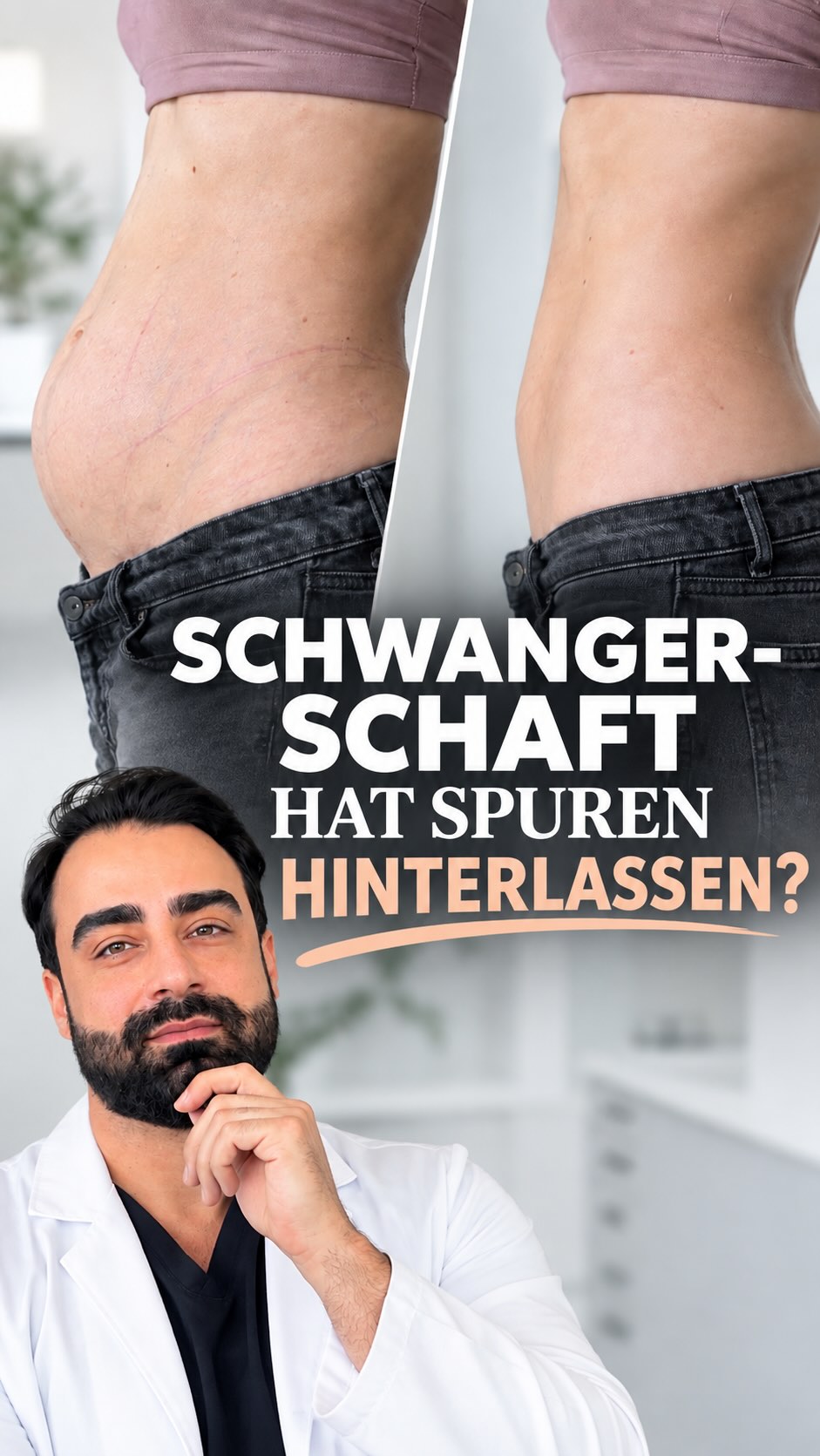 Mehrere Schwangerschaften können Spuren hinterlassen.
Eine ausgeprägte Rektusdiastase kann nicht nur eine ästhetische Veränderung darstellen, sondern auch medizinisch relevant sein.

#noahklinik #plastischechirurgie #ästhetischechirurgie #Rektusdiastase #bauchdeckenstraffung