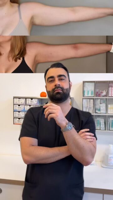 ✨ Ergebnis nach Fettabsaugung bei Lipödem – 6 Wochen danach ✨ In diesem Video seht ihr das Resultat sechs Wochen nach der Behandlung. Das Besondere: Zusätzlich zur Fettabsaugung haben wir die Haut mit moderner Quantum-Technologie gestrafft, um ein harmonisches und glattes Gesamtbild zu unterstützen. Jeder Körper ist individuell! Umso wichtiger ist eine ganzheitliche und schonende Behandlung. 💬 Habt ihr Fragen zur Behandlung oder zum Ablauf? Schreibt sie gerne in die Kommentare! #Lipödem #fettabsaugung #noahklinik #medizinischeindikation #kassel #quantumtechnology