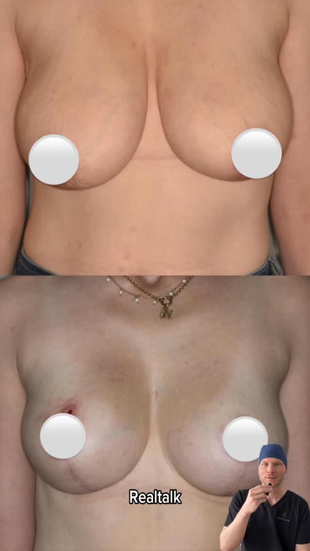 👇 Mehr Infos zum Fall: Medizinische Indikation: Wiederherstellung der Körperstatik ​Infolge einer Schilddrüsenresektion und einer Ernährungsumstellung reduzierte die Patientin ihr Körpergewicht um insgesamt 34 kg. ​Der Verlust des stützenden Fettgewebes führte zu einer ausgeprägten Gewebeerschlaffung und einer Mastoptosis (Hängebrust) Grad III. In diesem Stadium liegt die Brustwarze deutlich unterhalb der Unterbrustfalte. Es resultierte daraus eine pathologische Fehlbelastung der Wirbelsäule mit chronischen Schmerzen bei auch starken Verspannungen im Nacken- und Rückenbereich (HWS-/BWS-Syndrom). ​Weiterhin kam es zu rezidivierenden Hautirritationen und Intertrigo in den Unterbrustfalten. ​Unsere Lösung bei gegebener medizinischer Indikation: ​Um eine dauerhafte Stabilität und ein natürliches Volumen ohne Fremdkörper zu erreichen, wurde eine spezialisierte Form der Bruststraffung angewandt: Mastopexie mit der Autoprothesen-Technik. ​Was bedeutet das konkret? Statt das verbliebene Eigengewebe lediglich zu straffen oder durch Silikonimplantate zu ersetzen, wird das vorhandene Drüsen- und Fettgewebe der Patientin umgeformt. Hierzu wird das tief abgesackte Gewebe des unteren Brustpols präpariert, nach oben geschwenkt und an der tiefen Muskelfaszie tief unter dem Hautmantel fixiert. Dabei wird das Brustdrüsen- /fettgewebe als körpereigenes „Implantat“ geformt. ​Rechtlicher Hinweis ​Die Veröffentlichung dieser klinischen Dokumentation dient der medizinischen Aufklärung über die Behandlung funktioneller Beschwerden nach massivem Gewichtsverlust gemäß § 11 HWG. Eine schriftliche Einwilligung der Patientin liegt vor. #noahklinik #plastischechirurgie #ästhetischechirurgie #bruststraffung #plasticsurgery