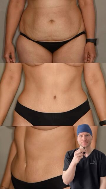 Medizinische Rekonstruktion der Bauchwand ✨Nach zwei Schwangerschaften zeigte sich eine ausgeprägte Bauchwandinstabilität mit Rektusdiastase sowie eine symptomatische Hautschürze am Unterbauch.Im Rahmen der Operation erfolgte eine anatomische Rektusraffung zur Wiederherstellung der muskulären Stabilität sowie die Entfernung von 1.037 g Haut-Fett-Gewebe.Ergänzend wurde eine ultraschall-assistierte Liposuktion (2.100 ml) zur Konturierung von Flanken und Rücken durchgeführt.Ziel: Wiederherstellung der Bauchwandintegrität, Entlastung der Körpermitte und eine funktionell stabile sowie harmonische Silhouette 📌 Medizinisch indizierter Eingriff (§ 11 HWG)#plastischechirurgie #noahklinik #plasticsurgery #ästhetischechirurgie #rektusdiastase