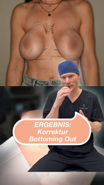 Mehr Infos zum Fall 👇Korrektur einer Implantat-Malposition (Bottoming-out)Dieser Fall zeigt die plastisch-chirurgische Korrektur nach einer auswärtigen Brustvergrößerung.Aufgrund eines schwachen Bindegewebes und des hohen Eigengewichts der Implantate (450 cc) kam es zu einem massiven Absinken der Implantate weit unter die natürliche Unterbrustfalte.Es ist damit zu einem ausgeprägten „Bottoming-out“ gekommen. Die Implantate dislozierten beidseits ca. 2–3 cm nach kaudal (unten). Dies führte zu einer erheblichen Ptosis (Hängebrust), einer Ausdünnung des Weichteilmantels im oberen Pol sowie einer schmerzhaften Fehlstatik. Durch den nach unten verlagerten Schwerpunkt entstand eine erhebliche Hebelwirkung auf die Wirbelsäule, was bei der Patientin zu chronischen Rücken- und Nackenschmerzen sowie Haltungsschäden führte.❕Unsere operative Lösung zur Rekonstruktion:Implantatwechsel: Austausch gegen deutlich leichtere (B-Lite®️) und kleinere Implantate (300 cc), um den statischen Druck auf den Halteapparat und die Wirbelsäule nachhaltig zu reduzieren.Mastopexie: Straffung des überschüssigen Hautmantels und anatomische Neupositionierung des Brustwarzen-Areolen-Komplexes.Interne Stabilisierung: Rekonstruktion der Unterbrustfalte und Einsatz eines stützenden Netzes (GalaFlex®️), um ein erneutes Absinken im Sinne eines „inneren BHs“ zu verhindern.Damit konnte eine stabile, anatomisch korrekte Brustform wiederhergestellt und die durch die Fehlstatik verursachten körperlichen Beschwerden beseitigt werden.Rechtlicher Hinweis:Die Veröffentlichung dieser Vorher-Nachher-Dokumentation erfolgt ausschließlich zum Zweck der medizinischen Aufklärung über die Korrektur behandlungsbedürftiger Komplikationen und pathologischer Gewebeveränderungen nach einem Primäreingriff (§ 11 Abs. 1 Nr. 5 HWG). Es handelt sich hierbei um die Darstellung einer medizinisch indizierten Revisionsoperation zur Behebung funktioneller Beschwerden (Fehlstatik/Schmerzsyndrom). Die Patientin hat ihre ausdrückliche schriftliche Einwilligung zur anonymisierten Veröffentlichung gegeben.#noahklinik #plastischechirurgie #äst