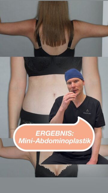 Mini abdominoplasty vs. major tummy tuck: What's the difference? 🤔Here you can see the post-operative result of a 34-year-old patient after two pregnancies. Despite intensive strength training, a deeply retracted caesarean scar remained where the tissue had painfully popped up.what is a mini abdominoplasty? in contrast to a major tummy tuck, the belly button remains completely untouched and is not moved. The procedure is significantly less invasive and is limited to the area below the navel. The old caesarean section scar is integrated into the incision and corrected.The individual treatment plan:1️⃣ Combination procedure: liposuction of the flanks, middle and lower back in the abdominal position and liposuction of the upper and middle abdomen in the supine position, combined with mini-abdominoplasty to remove excess skin and correct scars.2️⃣ Upper arm contouring: liposuction of the upper arms combined with BodyTite™️. Radiofrequency therapy with BodyTite™️ or Quantum™️ uses heat to maximise tissue tightening from the inside out - without any large scars on the arms. At the end of the video you can see the harmonious result: a flat, functionally reconstructed stomach and firm upper arms with reduced circumference. Feel free to write them in the comments.⚠️ Legal notice: The postoperative presentation of results serves exclusively to provide medical information on the surgical correction of tissue changes and scar deformities (§ 11 HWG). No promise of cure. The patient has given her express written consent for anonymised publication.#Abdominoplasty #ummy tuck 1TP5Plastic surgery #noahklinik 1TP5Aesthetic surgery