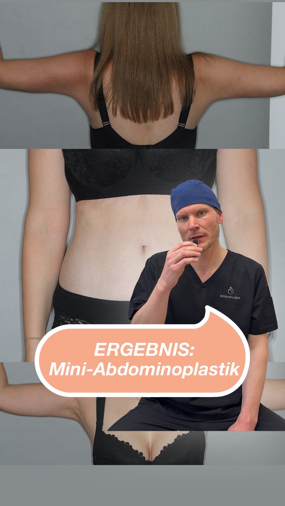 Mini-Abdominoplastik vs. große Bauchdeckenstraffung: Wo liegt der Unterschied? 🤔 Hier seht ihr das postoperative Ergebnis einer 34-jährigen Patientin nach zwei Schwangerschaften. Trotz intensivem Krafttraining verblieb eine tief eingezogene Kaiserschnittnarbe, an der sich das Gewebe schmerzhaft aufshoppte. Was ist eine Mini-Abdominoplastik? Im Gegensatz zur großen Straffung bleibt der Bauchnabel völlig unangetastet und wird nicht versetzt. Der Eingriff ist deutlich weniger invasiv und beschränkt sich auf den Bereich unterhalb des Nabels. Die alte Kaiserschnittnarbe wurde dabei in die Schnittführung integriert und korrigiert. Der individuelle Behandlungsplan: 1️⃣ Kombinations-Eingriff: Liposuktion der Flanken, des mittleren und unteren Rückens in Bauchlage und Liposuktion des Ober- und Mittelbauchs in Rückenlage, kombiniert mit der Mini-Abdominoplastik zur Entfernung des Hautüberschusses und zur Narbenkorrektur. 2️⃣ Oberarm-Konturierung: Liposuktion der Oberarme, kombiniert mit BodyTite™️. Die Radiofrequenz-Therapie mit BodyTite™️ oder mit Quantum™️ sorgt durch Hitze für eine maximale Gewebestraffung von innen heraus - ganz ohne große Narben an den Armen. Am Ende des Videos seht ihr das harmonische Ergebnis: Ein flacher, funktionell rekonstruierter Bauch und straffe Oberarme mit reduziertem Umfang. Fragen? Schreibt sie gerne in die Kommentare. ⚠️ Rechtlicher Hinweis: Die postoperative Ergebnisdarstellung dient ausschließlich der medizinischen Aufklärung über die chirurgische Korrektur von Gewebeveränderungen und Narbendeformitäten (§ 11 HWG). Kein Heilversprechen. Die Patientin hat ihre ausdrückliche, schriftliche Einwilligung zur anonymisierten Veröffentlichung erteilt. #Abdominoplastik #bauchdeckenstraffung #plastischechirurgie #noahklinik #ästhetischechirurgie
