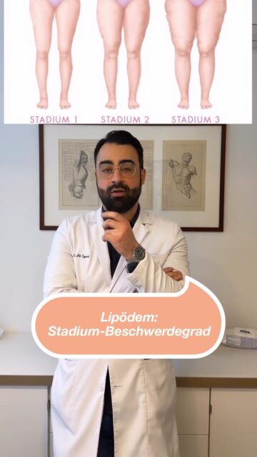 ✨Lipödem: Stadium- Beschwerdegrad Beim Lipödem geht es nicht um das Aussehen, sondern um die Beschwerden. Die Stadien (1–3) beschreiben Gewebeveränderungen, nicht die Schmerzintensität. Deshalb können Patientinnen in Stadium 1 stärkere Beschwerden haben als in Stadium 2 oder 3. Entscheidend ist immer das individuelle Beschwerdebild.✨ Wenn ihr weitere Fragen habt, schreibt sie uns gerne in die Kommentare!