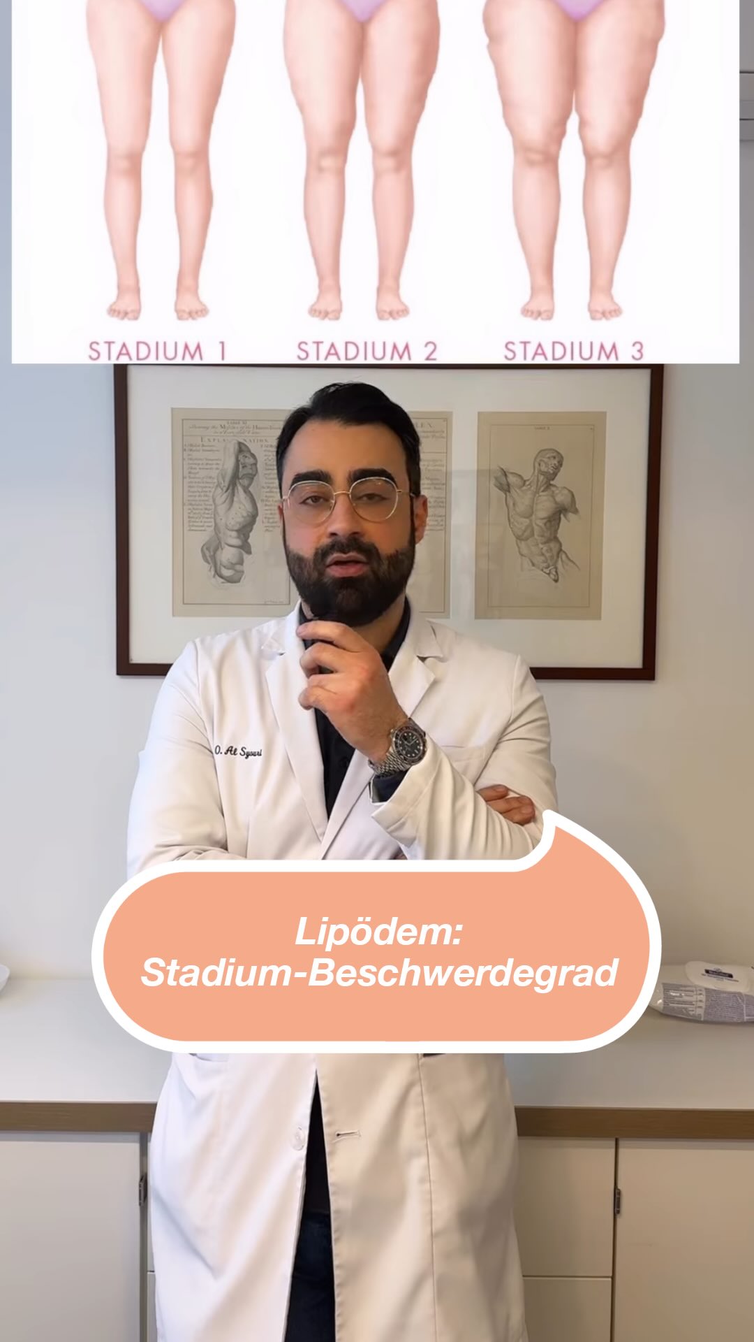 ✨Lipödem: Stadium- Beschwerdegrad Beim Lipödem geht es nicht um das Aussehen, sondern um die Beschwerden. Die Stadien (1–3) beschreiben Gewebeveränderungen, nicht die Schmerzintensität. Deshalb können Patientinnen in Stadium 1 stärkere Beschwerden haben als in Stadium 2 oder 3. Entscheidend ist immer das individuelle Beschwerdebild.✨ Wenn ihr weitere Fragen habt, schreibt sie uns gerne in die Kommentare!