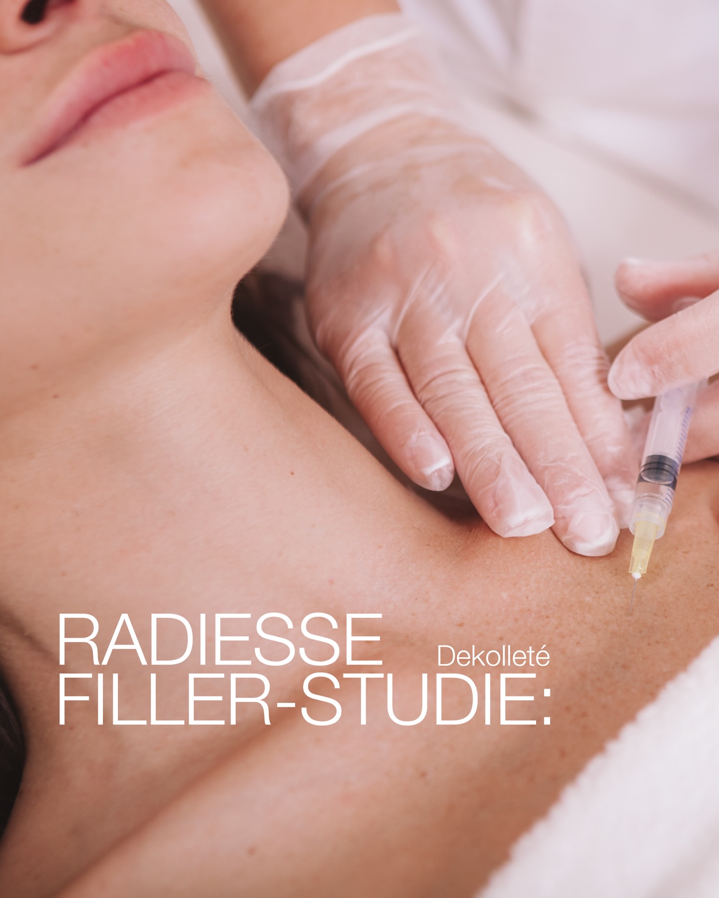 ✨ Radiesse Filler-Studie – Dekolleté ✨ Im Rahmen einer klinischen Post-Market-Studie untersuchen wir die Sicherheit und Wirksamkeit von Radiesse zur Behandlung moderater bis stark ausgeprägter Falten im Dekolleté. Teilnahme ab 18 Jahren, keine obere Altersbegrenzung. 📩 Interesse an einer Teilnahme? E-Mail an studienzentrum@noahklinik.de Betreff: Radiesse-Studie