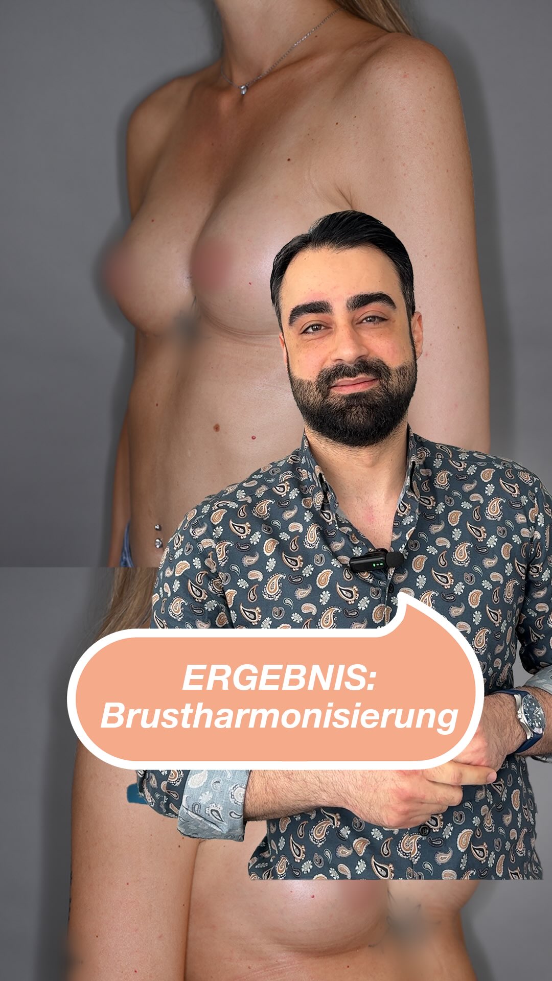 Von A auf B mit der MIA-Methode zur Brustharmonisierung. 👉Ein Ergebnis, das die eigene Form unterstreicht, ohne künstlich zu wirken. #noahklinik #plastischechirurgie #ästhetischechirurgie #brustvergrößerung #kassel