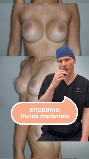 Brustvergrößerung mit Brustimplantaten mit einen runden Profil (= umgangssprachlich runde Implantate) Die 23-jährige Patientin stellte sich mit dem Wunsch nach einer Brustvergrößerung vor. Ihr Anliegen war ein rundes Implantatprofil zur Betonung des Dekolletés. Nach genauer Untersuchung und Beratung erfolgte die Operation mit Implantaten der Firma Motiva® in subfaszialer Technik. Das Ergebnis entspricht dem präoperativ besprochenen Ziel. Im nächsten Beitrag möchten wir euch die Details zur Implantatplanung und zum Ausgleich der Asymmetrie vorstellen. #noahklinik #plastischechirurgie #ästhetischechirurgie #Brustvergrößerung #drericklingelhöfer