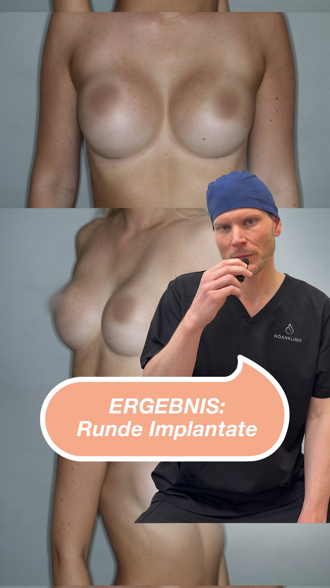 Brustvergrößerung mit Brustimplantaten mit einen runden Profil (= umgangssprachlich runde Implantate) Die 23-jährige Patientin stellte sich mit dem Wunsch nach einer Brustvergrößerung vor. Ihr Anliegen war ein rundes Implantatprofil zur Betonung des Dekolletés. Nach genauer Untersuchung und Beratung erfolgte die Operation mit Implantaten der Firma Motiva® in subfaszialer Technik. Das Ergebnis entspricht dem präoperativ besprochenen Ziel. Im nächsten Beitrag möchten wir euch die Details zur Implantatplanung und zum Ausgleich der Asymmetrie vorstellen. #noahklinik #plastischechirurgie #ästhetischechirurgie #Brustvergrößerung #drericklingelhöfer